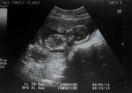Pour la première fois un enfant subit une chirurgie cérébrale in utero : une intervention historique le sauve d'une malformation