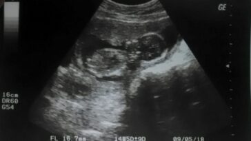 Pour la première fois un enfant subit une chirurgie cérébrale in utero : une intervention historique le sauve d'une malformation 27 Pour la première fois un enfant subit une chirurgie cérébrale in utero : une intervention historique le sauve d'une malformation
