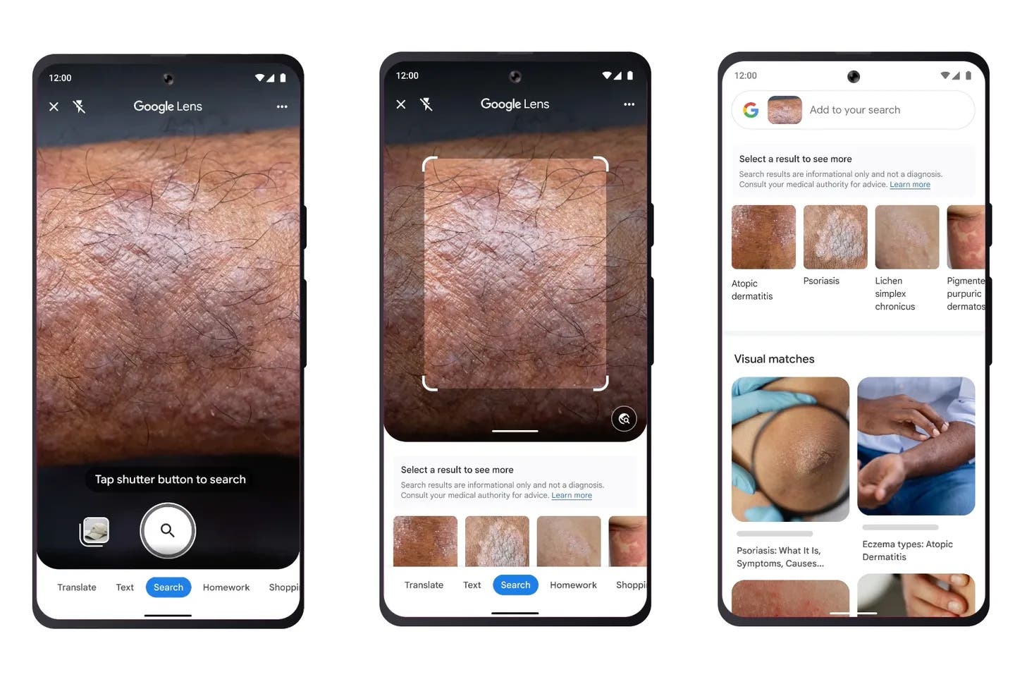 Google Lens utilise désormais la puissance de l'IA pour identifier si vous avez des problèmes de peau 2 Fonction d'identification de la peau de Google Lens