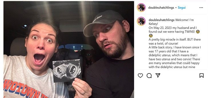 Née avec deux utérus, elle accouche deux fois en deux jours : comment est-ce possible 3 Kelsey Hatcher avec son mari, montre l'échographie de sa grossesse gémellaire dicavitary / Crédit : @doubleuhatchlings/Instagram
