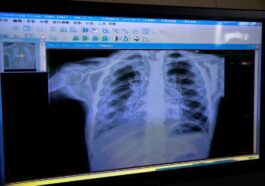 Bronchioliti nei bambini, il vaccino contro il virus respiratorio sinciziale riduce ricoveri dell’83%