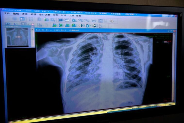 Bronchiolite chez les enfants : le vaccin contre le virus respiratoire syncytial réduit les hospitalisations de 83% 1 Bronchioliti nei bambini, il vaccino contro il virus respiratorio sinciziale riduce ricoveri dell’83%