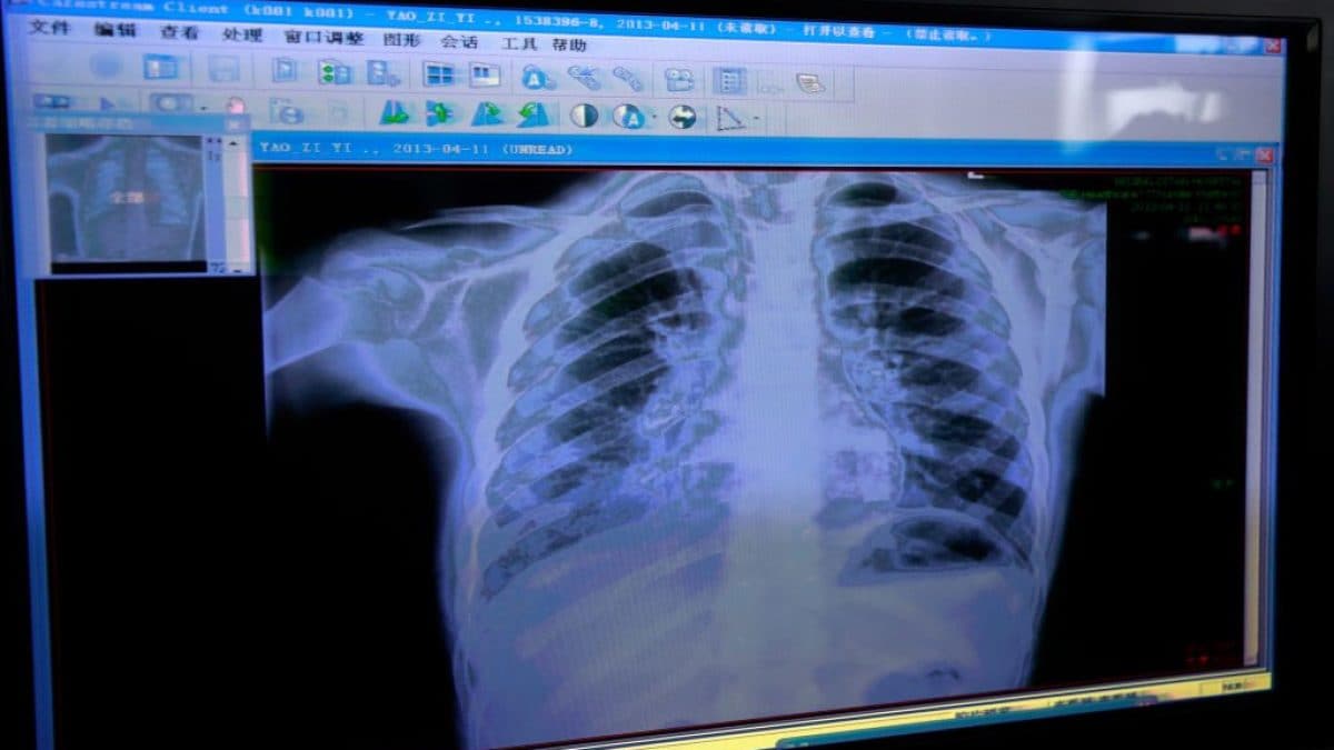 Bronchiolite chez les enfants : le vaccin contre le virus respiratoire syncytial réduit les hospitalisations de 83% 2 Bronchiolite chez les enfants le vaccin contre le virus