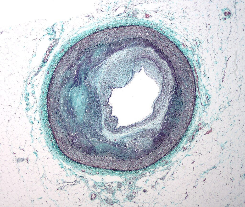 Qu'est-ce que l'angioplastie coronarienne et quels sont les risques de l'intervention que Gigi Riva aurait dû subir 4 Une artère avec une athérosclérose. Crédit : wikipedia