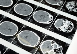 Questo test del sangue può rilevare il tumore al cervello: come funziona