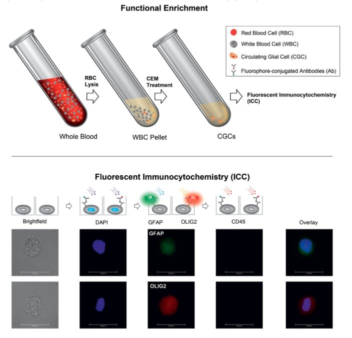 Ce test sanguin peut détecter le cancer du cerveau : comment ça fonctionne 3 INTERNATIONAL JOURNAL OF CANCER | Une image de l'étude sur le test sanguin