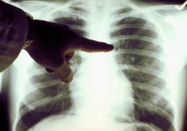 Farmaco per tumore ai polmoni in non fumatori, AIFA approva il Lolartinib: efficacia ed effetti collaterali