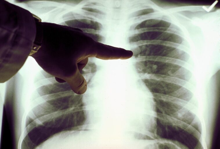 Médicament contre le cancer du poumon chez les non-fumeurs, l'AIFA approuve le Lolartinib : efficacité et effets secondaires 1 Farmaco per tumore ai polmoni in non fumatori, AIFA approva il Lolartinib: efficacia ed effetti collaterali