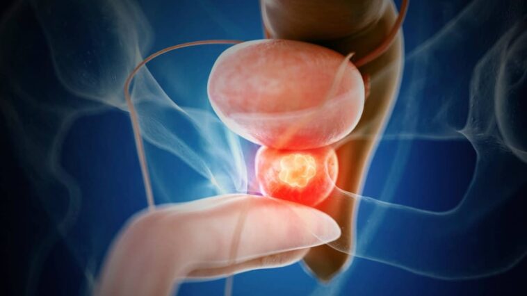 Amélioration de la condition physique réduit le risque de cancer de la prostate, selon une étude 1 Cancro da próstata