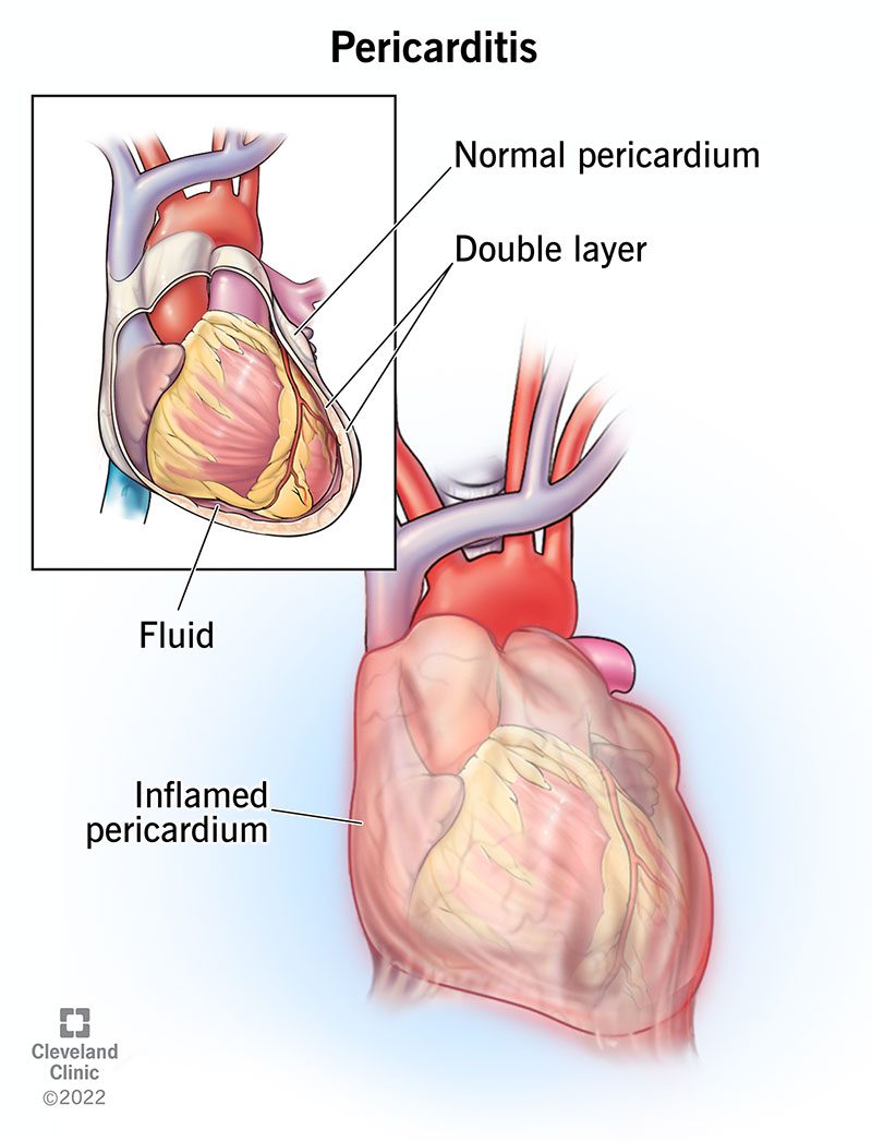 Illustration de la péricardite, l'inflammation du péricarde, la membrane qui entoure le cœur / Cleveland Clinic
