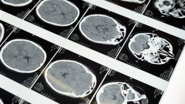 Lucas est le premier enfant au monde à guérir d'un cancer du cerveau mortel: espoir pour un traitement 13 Lucas è il primo bambino al mondo a guarire da un cancro al cervello mortale: speranze per una cura