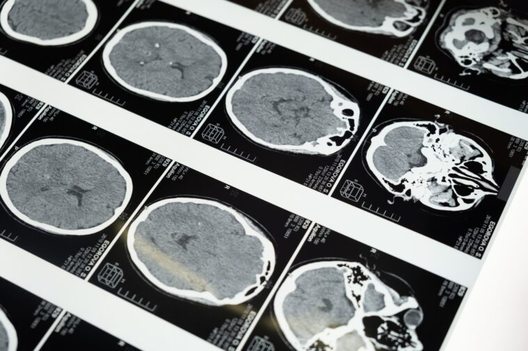 Lucas est le premier enfant au monde à guérir d'un cancer du cerveau mortel: espoir pour un traitement 1 Lucas è il primo bambino al mondo a guarire da un cancro al cervello mortale: speranze per una cura