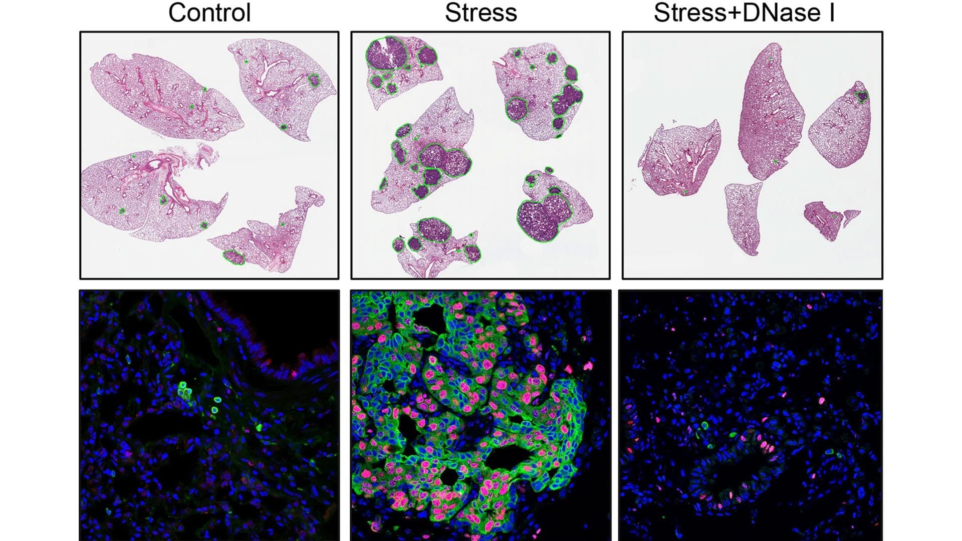 Le cancer s'est propagé plus rapidement chez les souris stressées (colonne du milieu) par rapport au groupe témoin (colonne de gauche). En comparaison, les cellules tumorales chez les souris stressées traitées avec une enzyme appelée DNase I (colonne de droite) étaient largement non proliférantes et le traitement a entraîné une réduction significative des métastases induites par le stress / Crédit : Xue-Yan He et al. Cancer Cell 2024