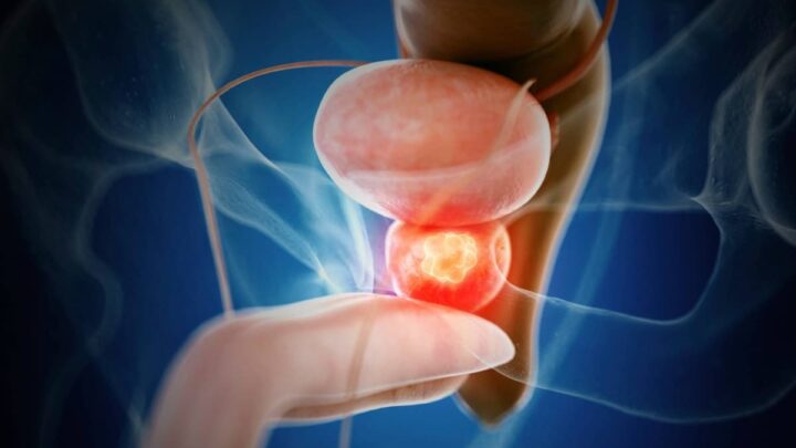 Amélioration de la condition physique réduit le risque de cancer de la prostate, selon une étude 2 Cancer de la prostate