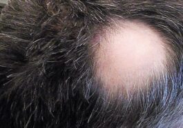 Chute de cheveux, qu'est-ce que Litfulo (ritlecitinib), la pilule pour le traitement de l'alopécie areata sévère 60 Crédit : Thirunavukkarasye-Raveendran / wikipedia