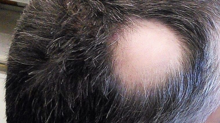Chute de cheveux, qu'est-ce que Litfulo (ritlecitinib), la pilule pour le traitement de l'alopécie areata sévère 1 Crédit : Thirunavukkarasye-Raveendran / wikipedia