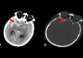 Images de TDM du crâne : les flèches rouges indiquent le corps étranger, qui s'est révélé être une aiguille d'acupuncture / Crédit : Journal of Medical Case Reports 2024