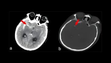 Se rend à l'hôpital dans un état confus mais découvre avoir une aiguille d'acupuncture dans le cerveau 28 Images de TDM du crâne : les flèches rouges indiquent le corps étranger, qui s'est révélé être une aiguille d'acupuncture / Crédit : Journal of Medical Case Reports 2024