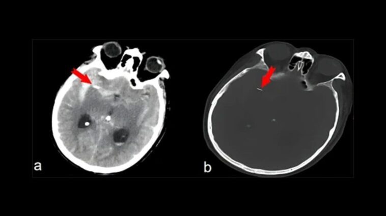 Se rend à l'hôpital dans un état confus mais découvre avoir une aiguille d'acupuncture dans le cerveau 1 Images de TDM du crâne : les flèches rouges indiquent le corps étranger, qui s'est révélé être une aiguille d'acupuncture / Crédit : Journal of Medical Case Reports 2024