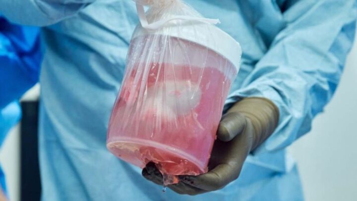 Inédit : transplantation de rein de porc chez un patient vivant 3 1711050864 697 Inedit transplantation de rein de porc chez un patient