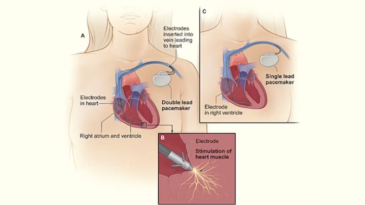 Pacemaker alimenté par la lumière élimine le besoin de piles 3 1711278401 999 Pacemaker alimente par la lumiere elimine le besoin de piles