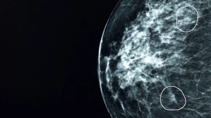 L'intelligence artificielle a détecté un cancer que les médecins n'ont pas détecté chez 11 femmes 3 1711486190 711 Lintelligence artificielle a detecte un cancer que les medecins nont