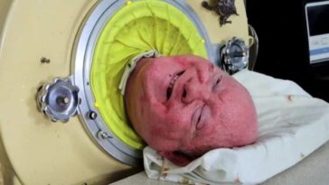 Comment Paul Alexander a réussi à vivre dans un poumon d'acier et devenir avocat 22 Image