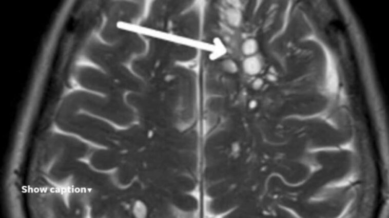 Mange du bacon et tombe malade : comment le ténia du porc peut infecter le cerveau 1 Image