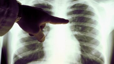Une alimentation riche en graisses et en sucres augmente le risque de cancer du poumon : les révélations d'une étude importante 26 Image