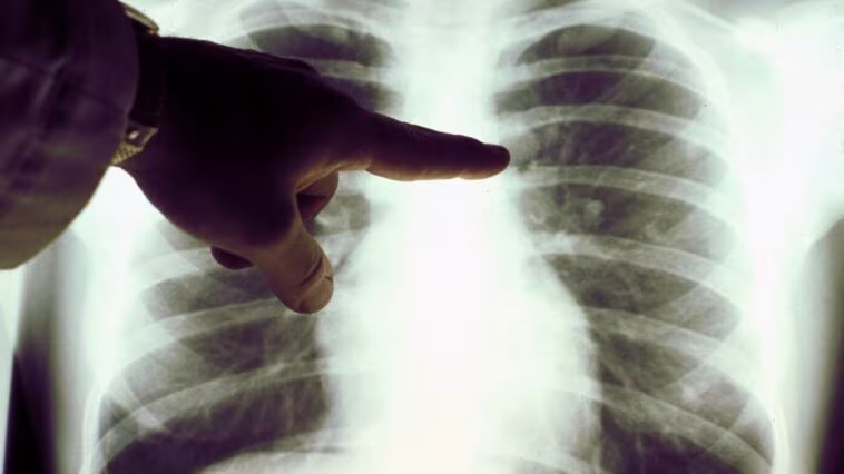 Une alimentation riche en graisses et en sucres augmente le risque de cancer du poumon : les révélations d'une étude importante 1 Image