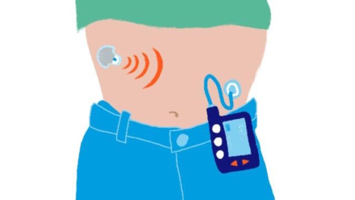 Le NHS d'Angleterre va fournir un "pancréas artificiel" aux personnes atteintes de diabète de type 1 3 Ilustração do Hybrid Closed Loop System (em português, sistema híbrido de circuito fechado). Fonte: Diabetes UK