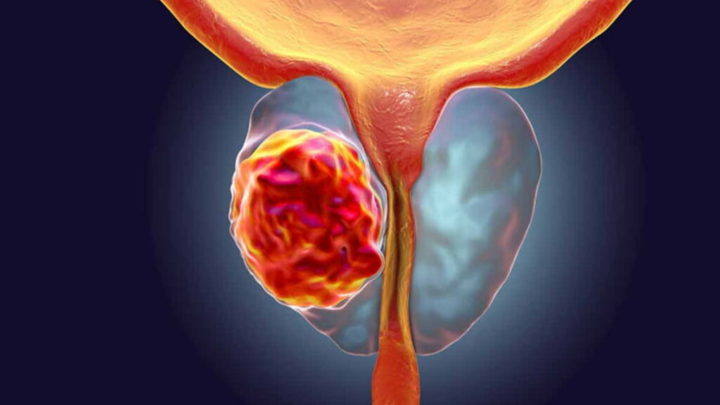 Les scientifiques prévoient que les cas de cancer de la prostate doubleront dans les 20 prochaines années 3 Cancer de la prostate