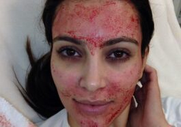 Kim Kardashian subito dopo essere stata sottoposta al lifting del vampiro. Credit: Kim Kardashian / Instagram