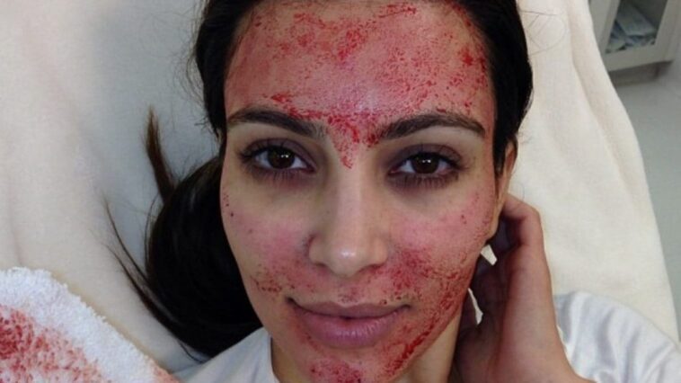 Cinq cas de VIH après un traitement esthétique connu sous le nom de "lifting vampire": qu'est-ce que c'est et comment il se réalise 1 Kim Kardashian subito dopo essere stata sottoposta al lifting del vampiro. Credit: Kim Kardashian / Instagram