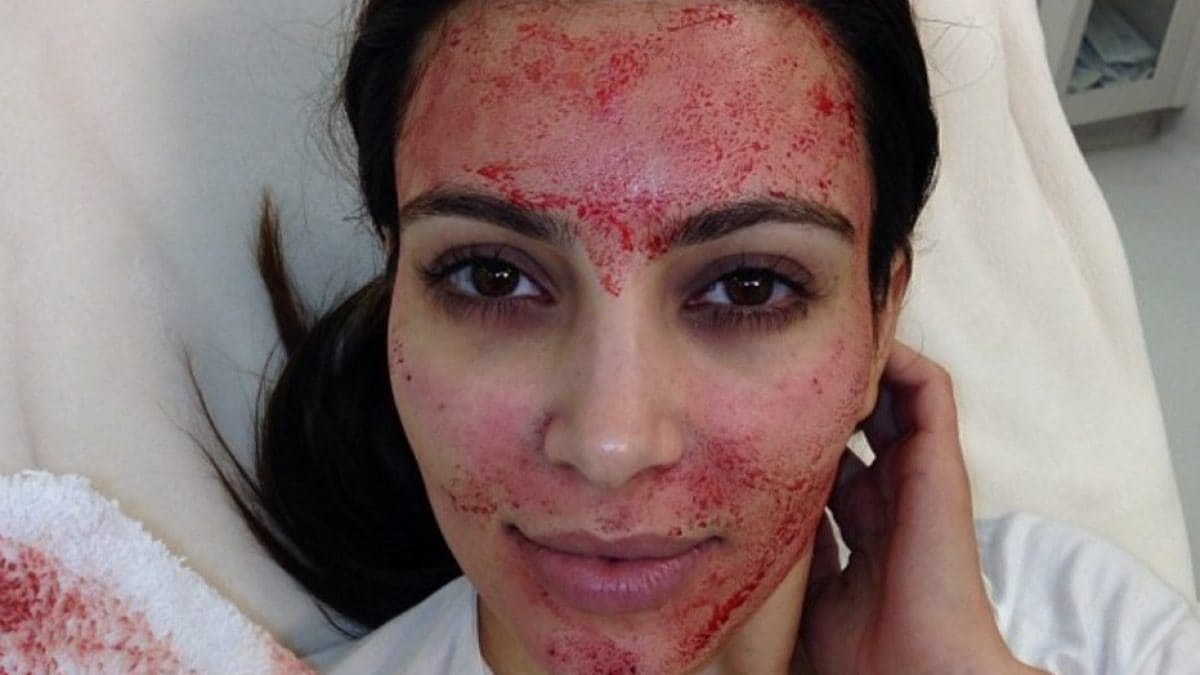Cinq cas de VIH après un traitement esthétique connu sous le nom de "lifting vampire": qu'est-ce que c'est et comment il se réalise 2 Kim Kardashian subito dopo essere stata sottoposta al lifting del vampiro. Credit: Kim Kardashian / Instagram