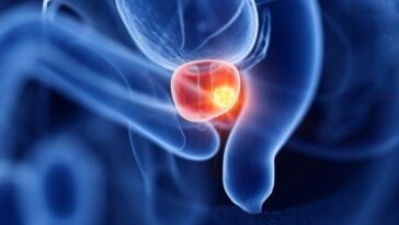 Les scientifiques prévoient que les cas de cancer de la prostate doubleront dans les 20 prochaines années 26 Cancer de la prostate