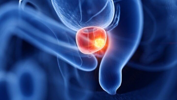 Les scientifiques prévoient que les cas de cancer de la prostate doubleront dans les 20 prochaines années 2 Cancer de la prostate