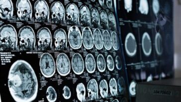 Pourquoi les tumeurs cérébrales sont-elles enlevées en étant éveillées et comment se déroule l'opération 8 Immagine