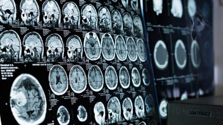 Pourquoi les tumeurs cérébrales sont-elles enlevées en étant éveillées et comment se déroule l'opération 1 Immagine