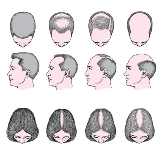 Chute de cheveux, le médicament utilisé par Trump peut causer des dysfonctionnements sexuels et des troubles psychiatriques 3 Progression de la perte de cheveux chez les hommes et les femmes atteints d'alopécie androgénétique / MSD Manuals