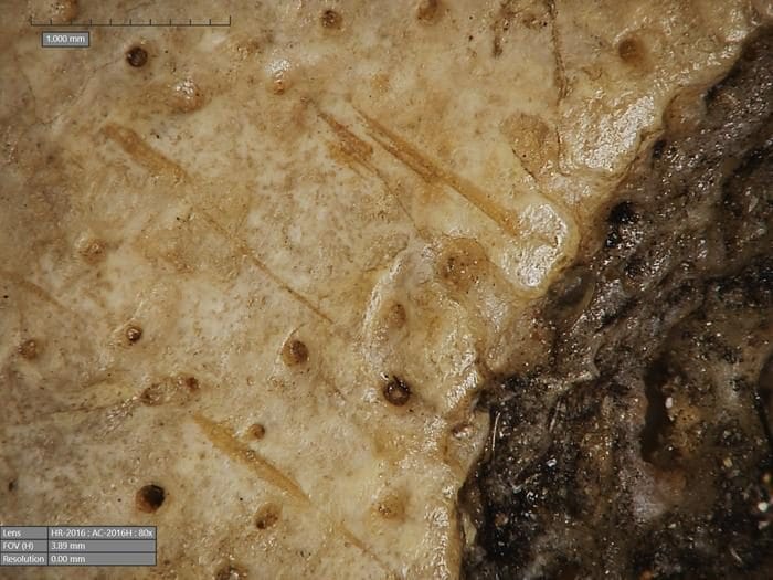 Les traces de coupes trouvées autour de la lésion cancéreuse, probablement réalisées avec un objet pointu / Crédit : Tondini T. et al., Frontiers in Medicine 2024