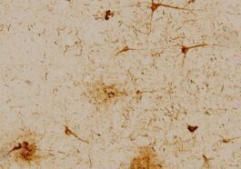 Alzheimer: découverte d'un signe décelable avant l'apparition des symptômes 64 Crédit: Institut de bioingénierie de Catalogne