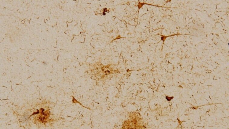 Alzheimer: découverte d'un signe décelable avant l'apparition des symptômes 1 Crédit: Institut de bioingénierie de Catalogne
