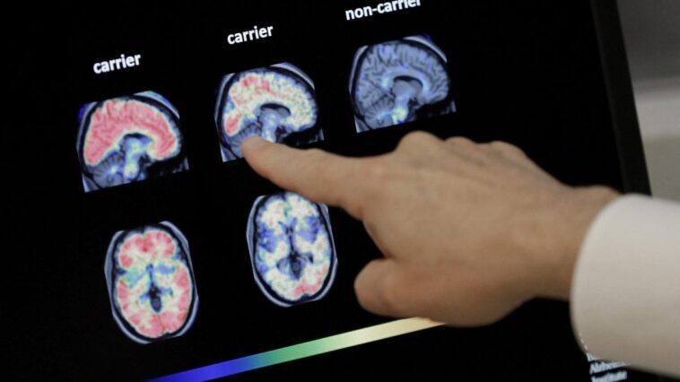 Spray nasal anti-Alzheimer élimine les protéines nocives et améliore la fonction cognitive dans les tests 1 Immagine