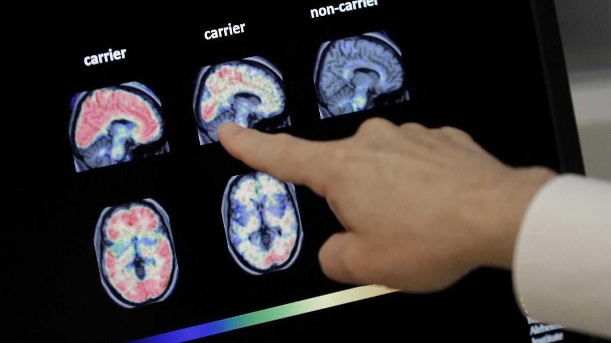 Spray nasal anti-Alzheimer élimine les protéines nocives et améliore la fonction cognitive dans les tests 2 Image