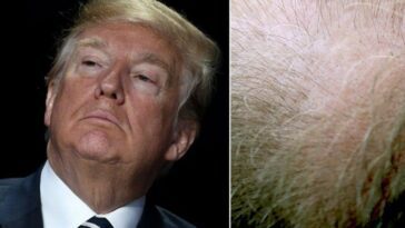 Chute de cheveux, le médicament utilisé par Trump peut causer des dysfonctionnements sexuels et des troubles psychiatriques 11 La finasteride, un farmaco contro la caduta dei capelli negli uomini, usato anche dall'ex presidente Donald Trump, può causare disfunzione sessuale e disturbi psichiatrici