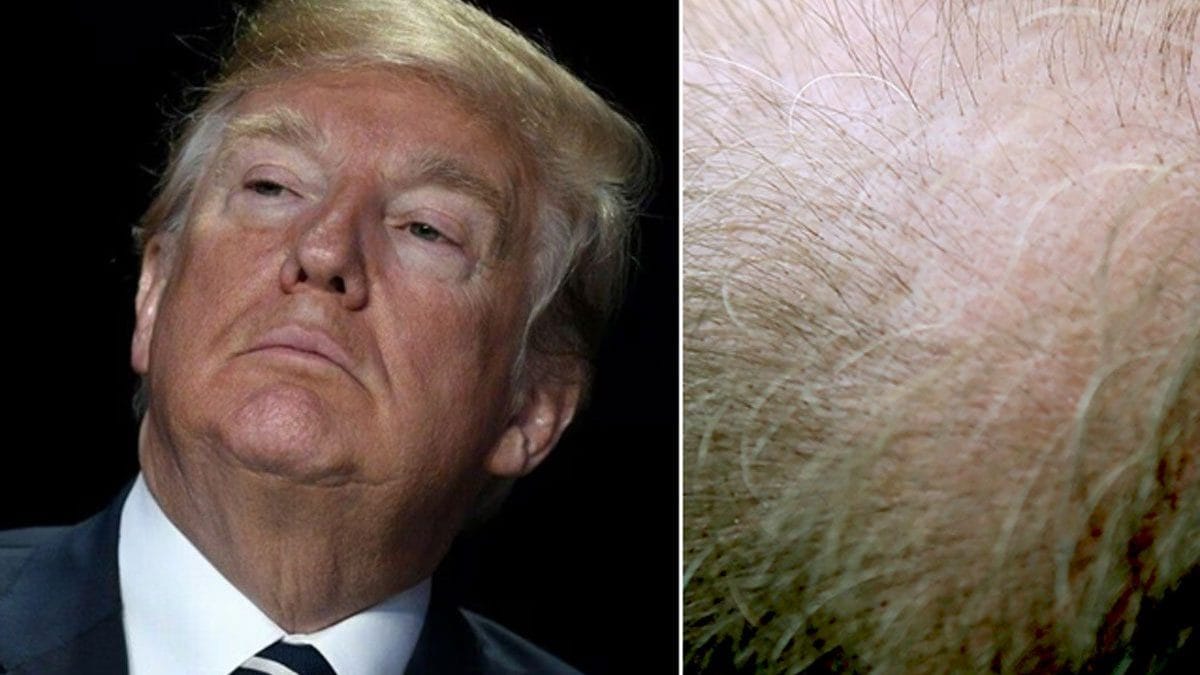 Chute de cheveux, le médicament utilisé par Trump peut causer des dysfonctionnements sexuels et des troubles psychiatriques 2 La finasteride, un farmaco contro la caduta dei capelli negli uomini, usato anche dall'ex presidente Donald Trump, può causare disfunzione sessuale e disturbi psichiatrici