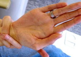 Uno dei segni della sindrome di Marfan è legato alla lunghezza delle dita: il pollice e il mignolo della mano che afferra il polso si sovrappongono / Credit: Staufenbiel I, et al. Wikipedia