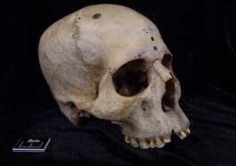 Un crâne de l'ancienne Egypte révèle comment le cancer du cerveau était "soigné" il y a plus de 4 000 ans 22 Un crâne de plus de 4 000 ans montre des traces de coupes autour des lésions cancéreuses / Crédit : Tondini T. et al., Frontiers in Medicine 2024)