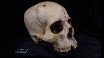 Un crâne de plus de 4 000 ans montre des traces de coupes autour des lésions cancéreuses / Crédit : Tondini T. et al., Frontiers in Medicine 2024)